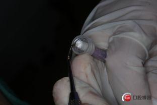 头尖手术成人能做吗视频,成人患者的治疗新选择