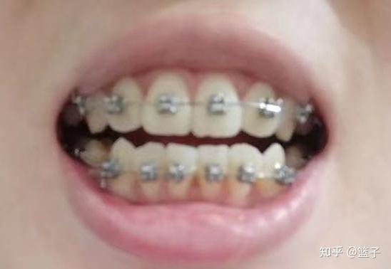 练习成人牙齿矫正视频